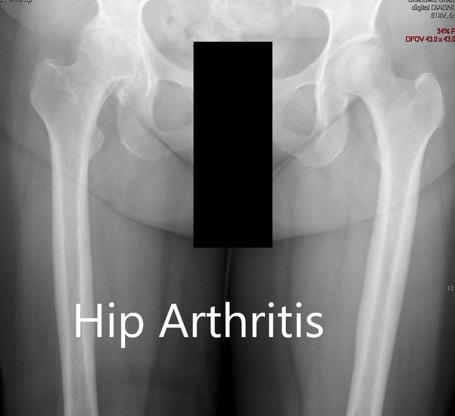 Preoperative X-ray showing the AP view of the pelvis with both hip joints Preoperative X-ray showing the AP view of the pelvis with both hip joints