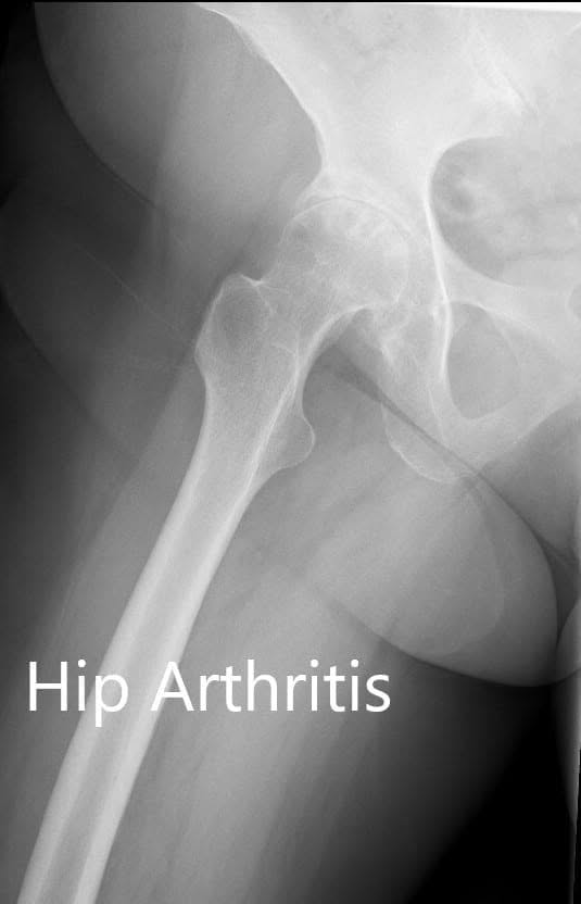 Preoperative X-ray showing the AP and the frog-legged lateral view of the right hip - img 2 Preoperative X-ray showing the AP and the frog-legged lateral view of the right hip - img 2