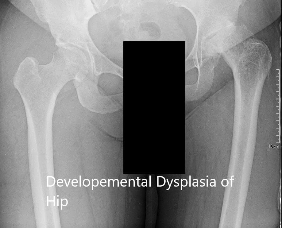 Radiografía que muestra la vista AP de la pelvis con ambas articulaciones de la cadera Radiografía que muestra la vista AP de la pelvis con ambas articulaciones de la cadera