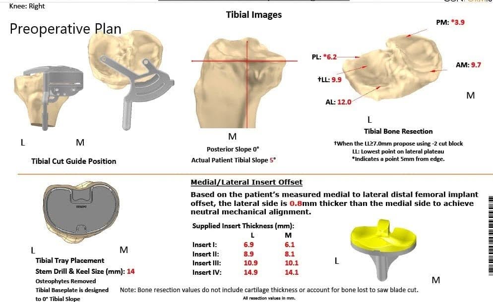 Plan quirúrgico completo de ortopedia específico para paciente para una artroplastia total de rodilla Left Custom en un hombre de 68 años