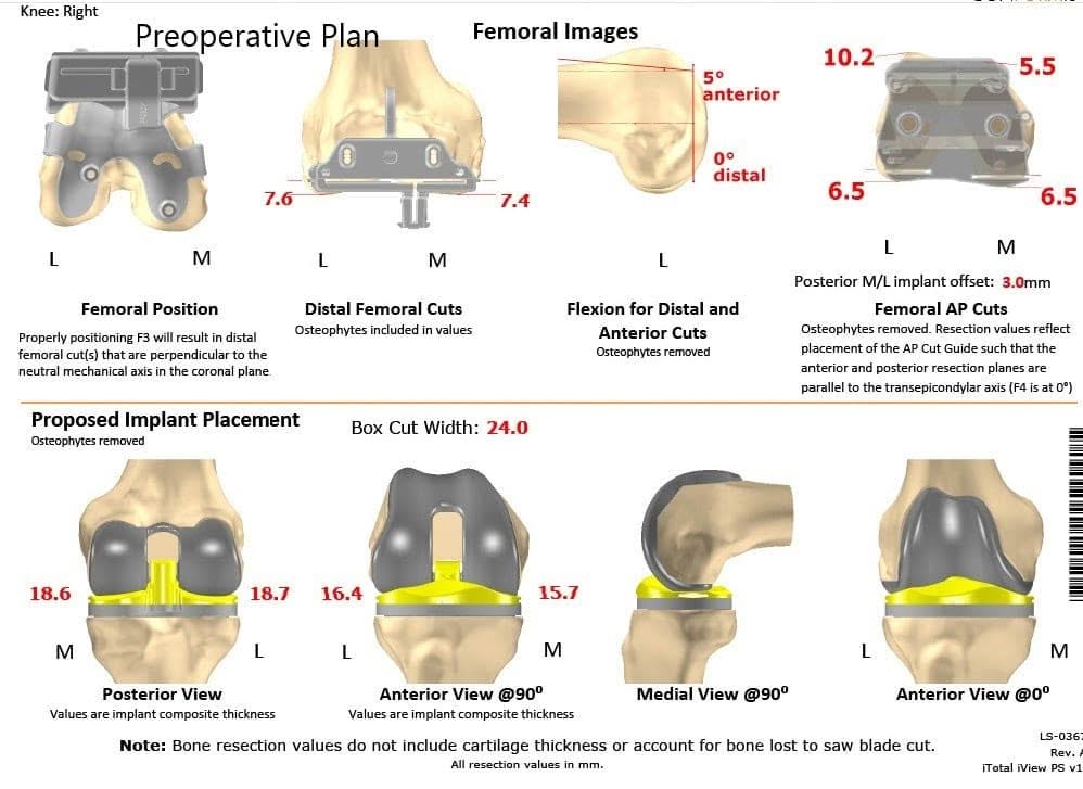 Plan quirúrgico específico para pacientes de Complete Orthopedics para una Artroplastia Total de Rodilla Personalizada Izquierda en un hombre de 68 años - escaneo 2