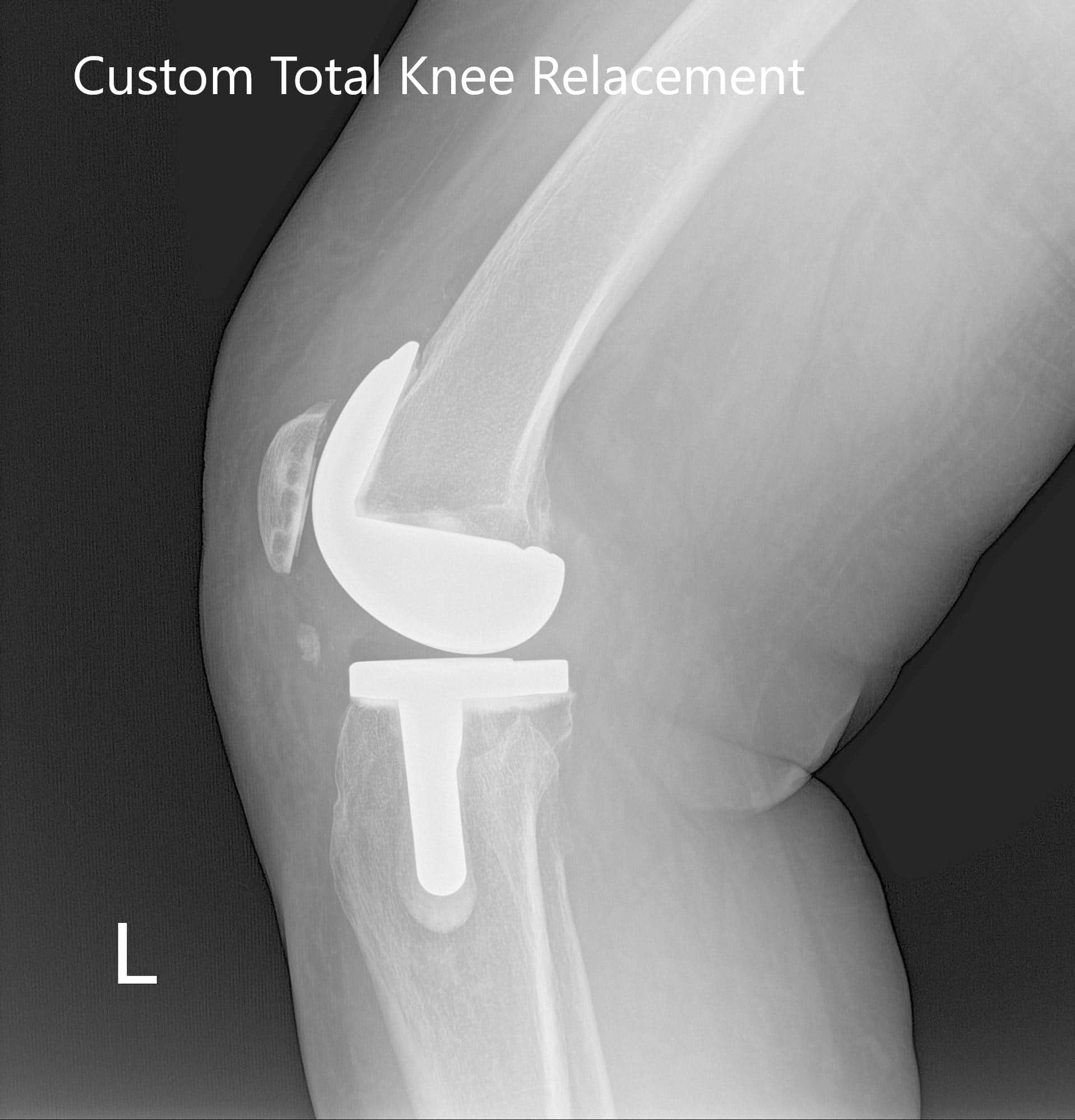 Radiografía postoperatoria de la rodilla izquierda que muestra visión AP y lateral