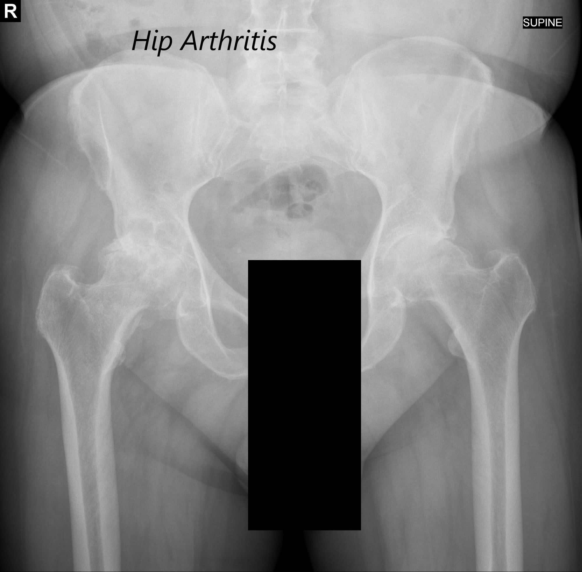 Vista AP de la radiografía de la pelvis mostrando ambas articulaciones de la cadera con vistas laterales en forma de pata de rana de las articulaciones de la cadera derecha e izquierda, lo que sugiere osteoartritis bilateral severa de las articulaciones de la cadera