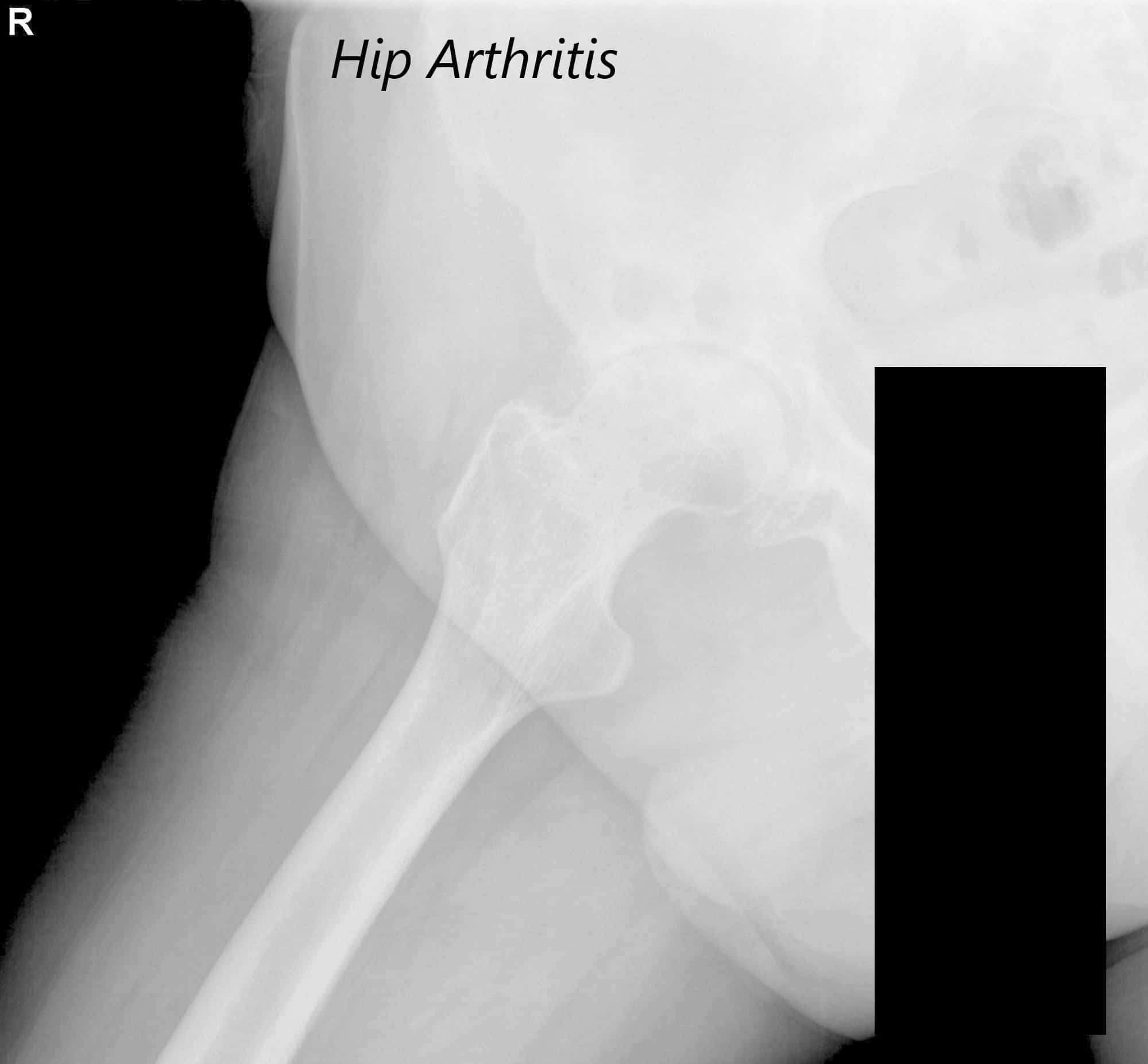 Vista AP de la radiografía de la pelvis que muestra ambas articulaciones de la cadera con vistas laterales de pata de rana de las articulaciones de la cadera derecha e izquierda, lo que sugiere osteoartritis bilateral severa de las articulaciones de la cadera - img 2