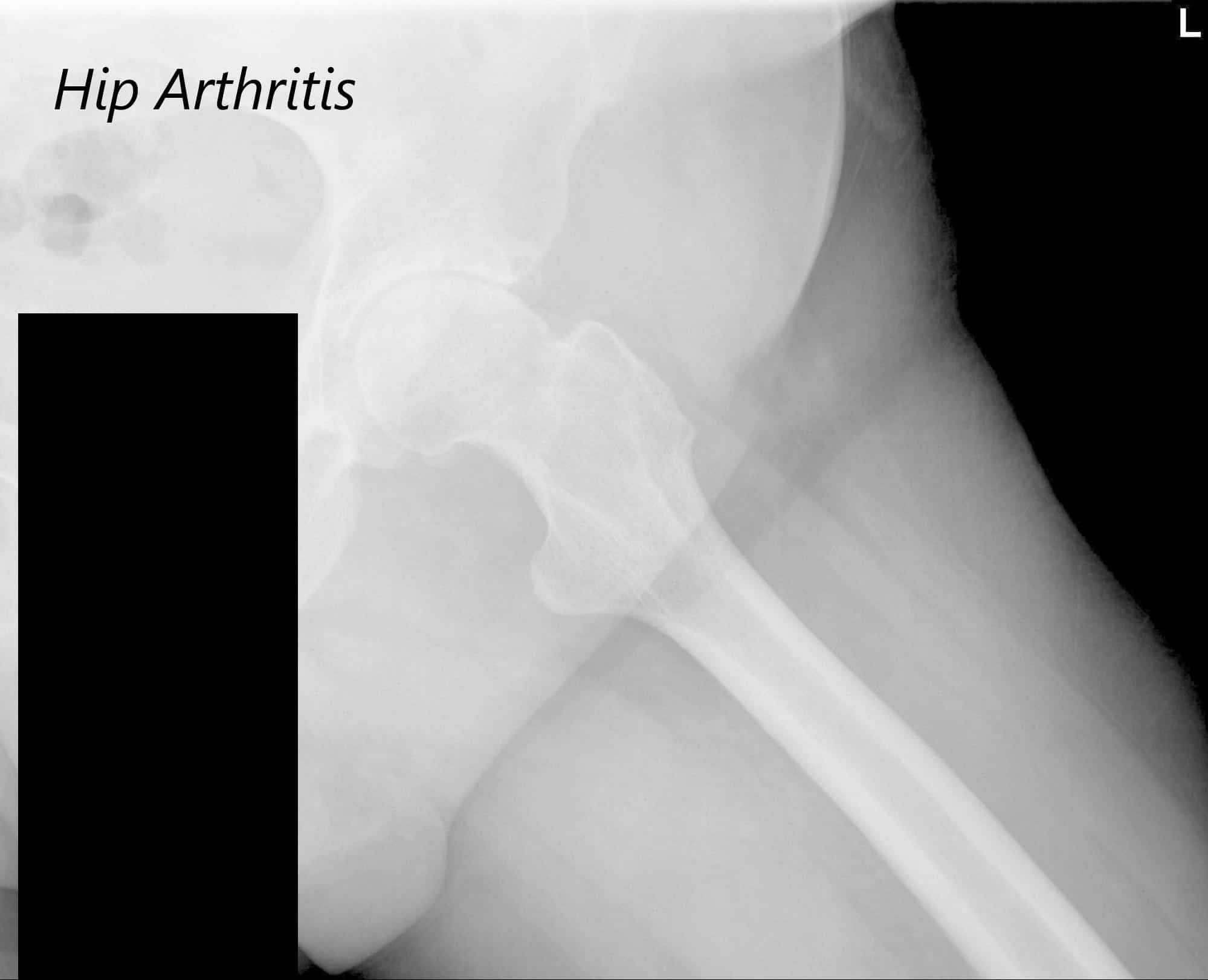 Vista AP de la radiografía de la pelvis mostrando ambas articulaciones de la cadera con vistas laterales en forma de pata de rana de las articulaciones derecha e izquierda, lo que sugiere osteoartritis bilateral severa de las articulaciones de la cadera - img 3