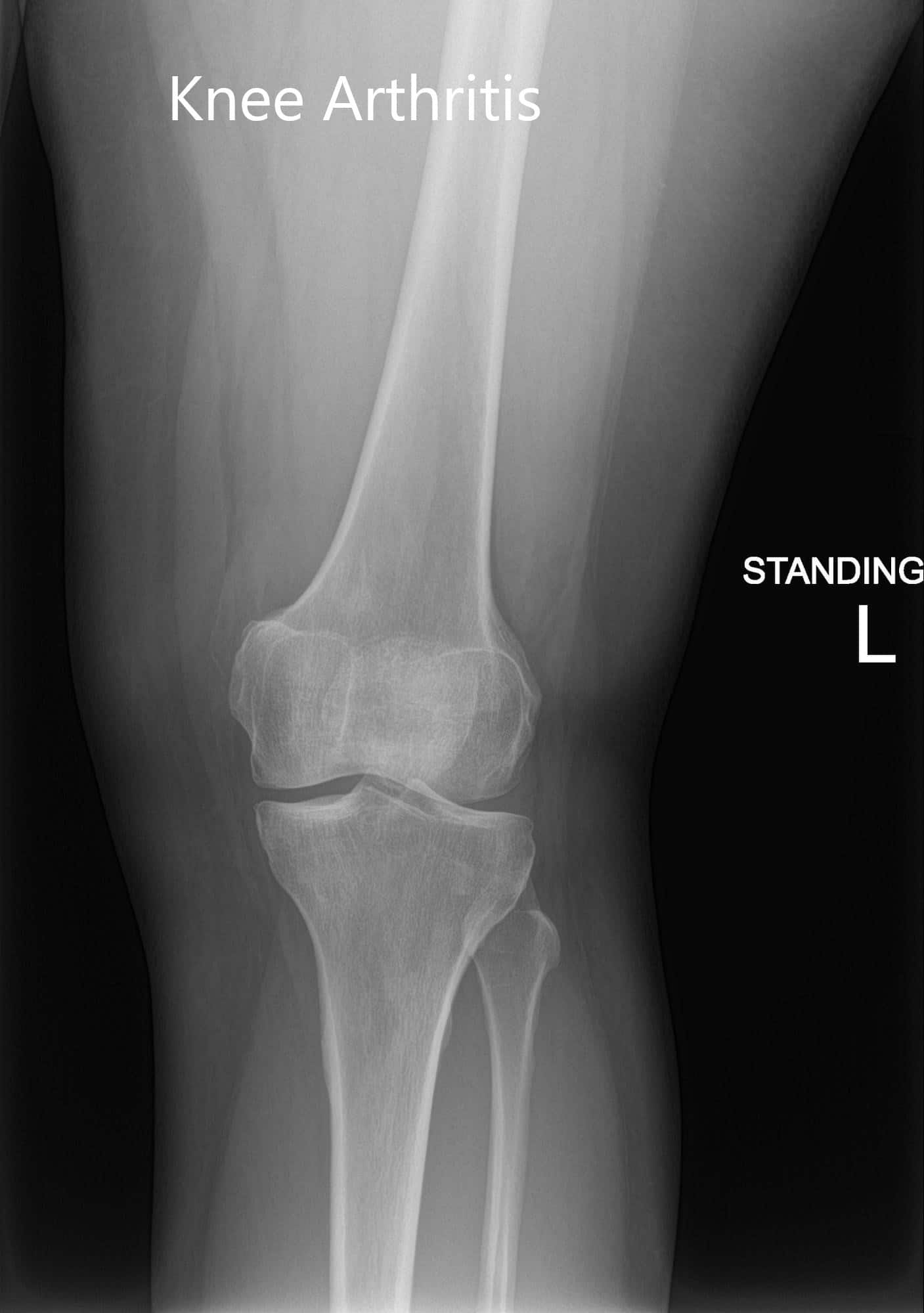 Radiografía preoperatoria de la rodilla izquierda que mostró imágenes AP y laterales