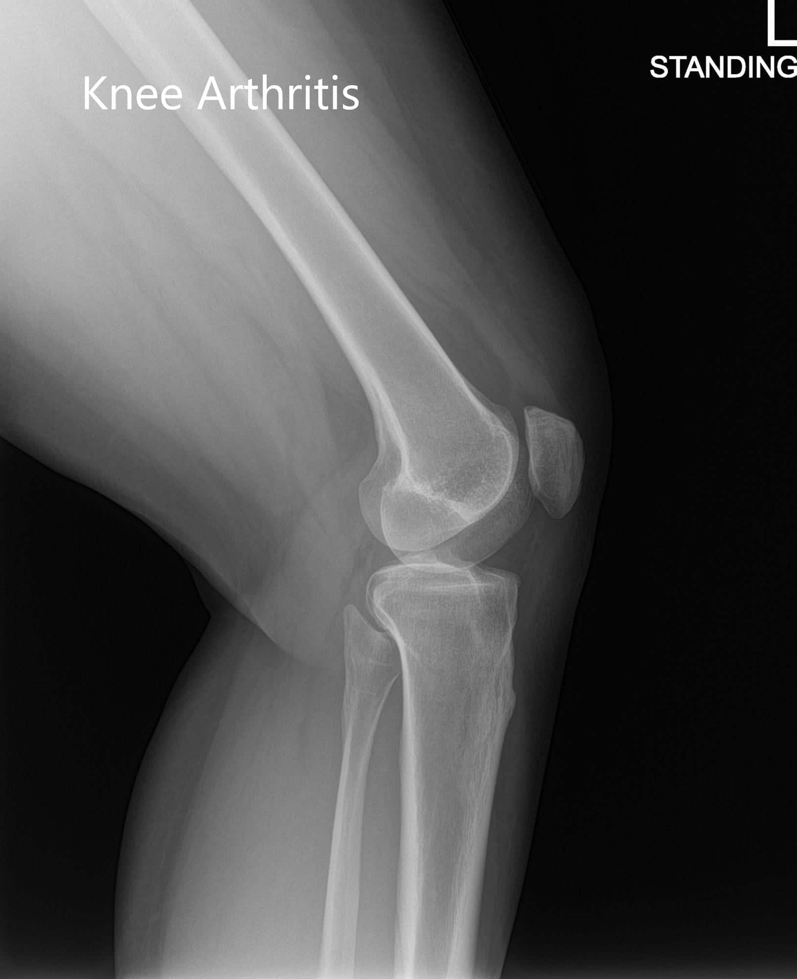 Radiografía preoperatoria de la rodilla izquierda que muestra imágenes AP e laterales - img 2