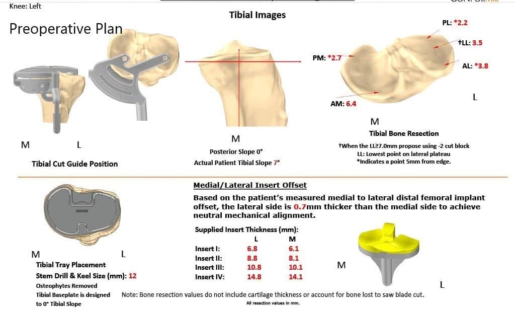 Complete Orthopedics patient specific surgical plan for a Custom Left Knee Replacement for Post-traumatic Arthritis in a 45-year-old Male