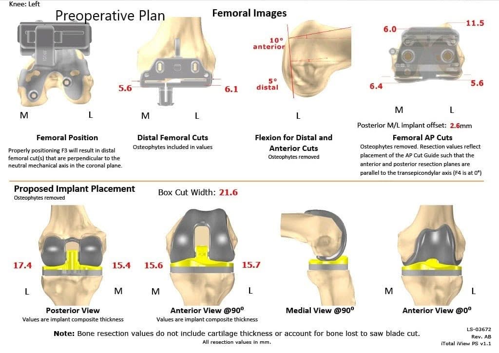 Plan quirúrgico completo específico para pacientes de Ortopedia para un reemplazo personalizado de rodilla izquierda para artritis postraumática en un hombre de 45 años - escaneo 2
