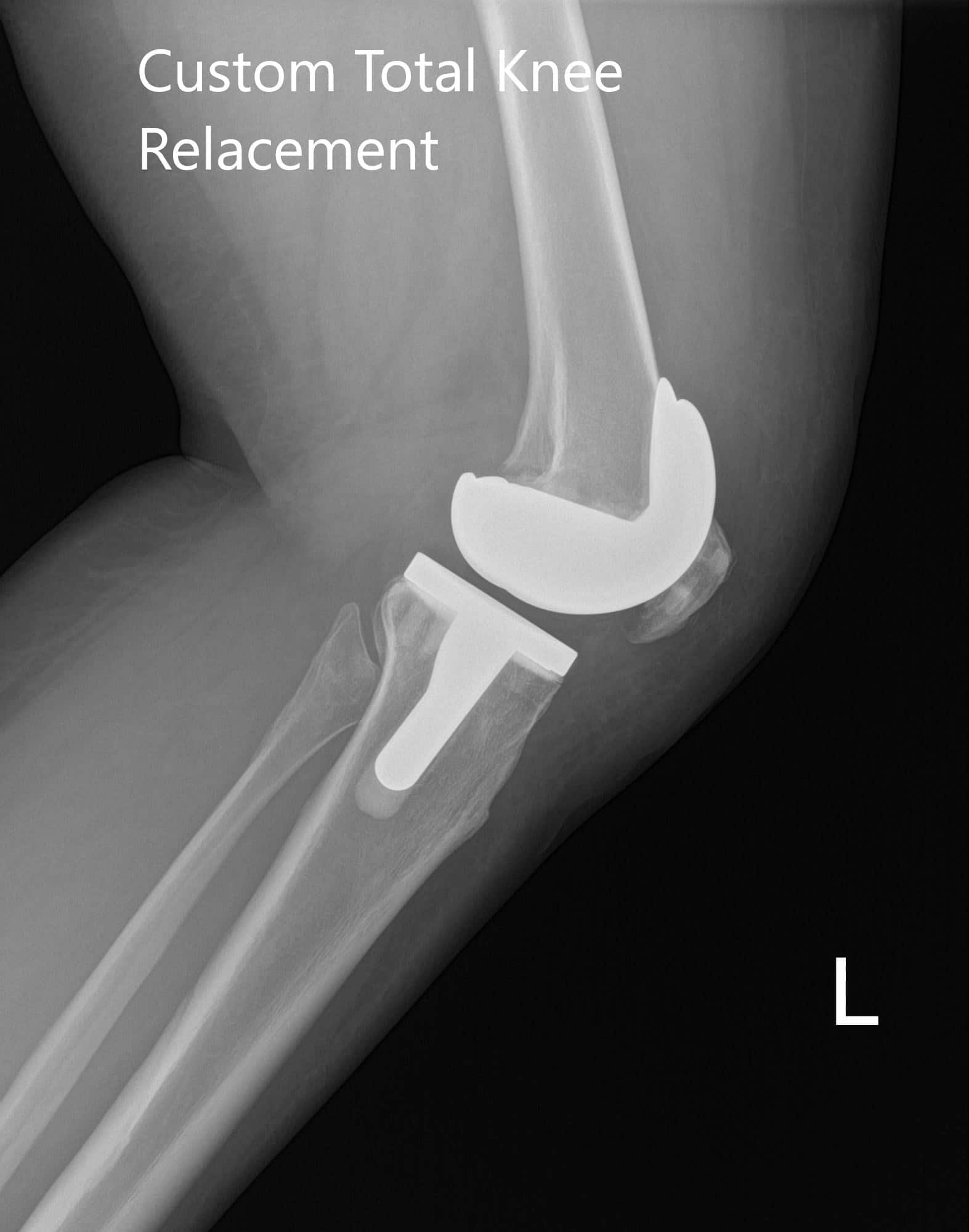 Radiografía postoperatoria de la rodilla izquierda que muestra imágenes AP y laterales - img 2 Radiografía postoperatoria de la rodilla izquierda que muestra imágenes AP y laterales - img 2