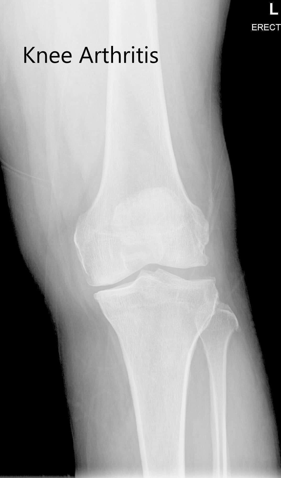 Radiografía preoperatoria de la rodilla izquierda que muestra visión AP y lateral - img 2
