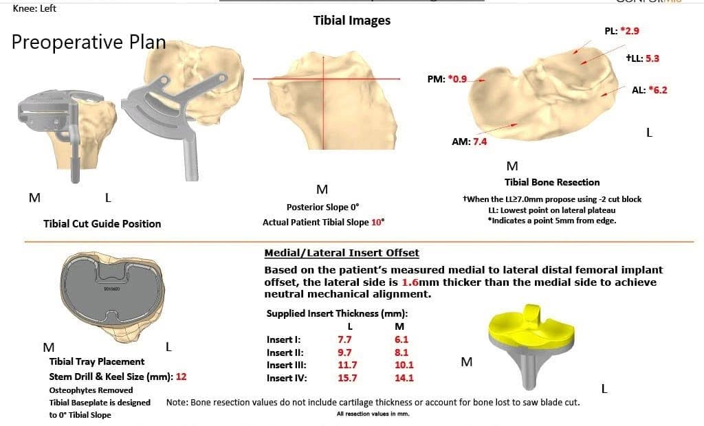 Plan quirúrgico completo específico para pacientes en ortopedia para un reemplazo personalizado de rodilla izquierda en una mujer de 67 años