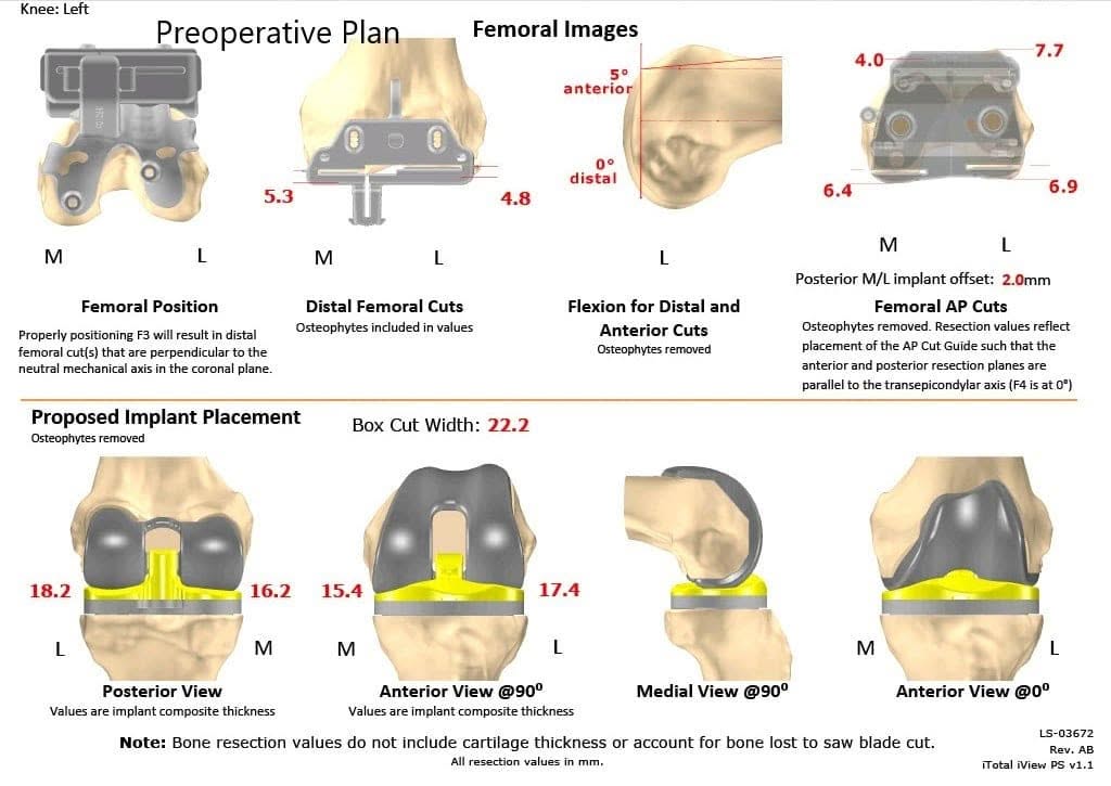 Plan quirúrgico completo de ortopedia específico para un reemplazo personalizado de rodilla izquierda en una mujer de 67 años - ecografía 2