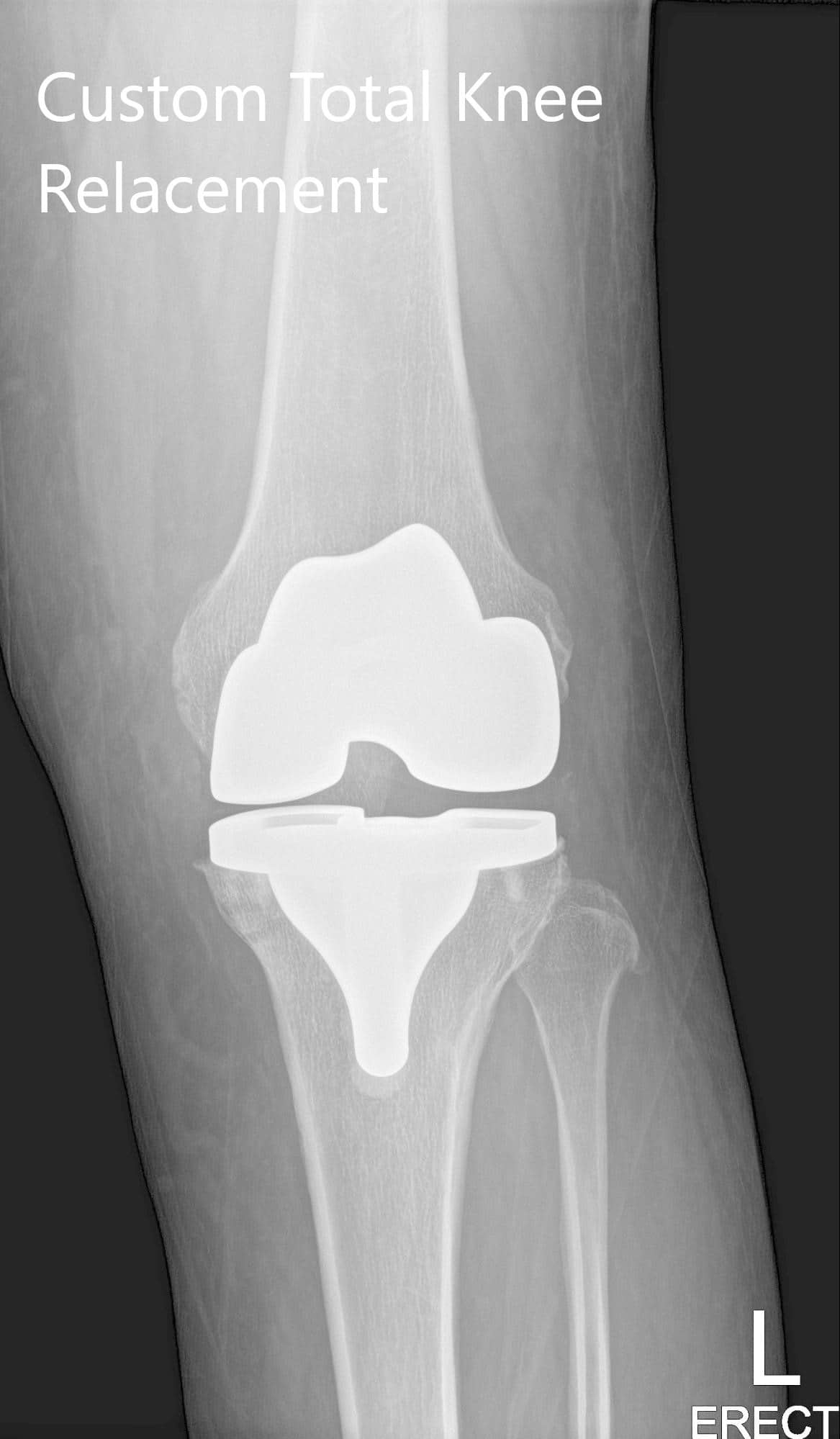 Imágenes de radiografías postoperatorias que muestran la visión AP y lateral de la rodilla izquierda