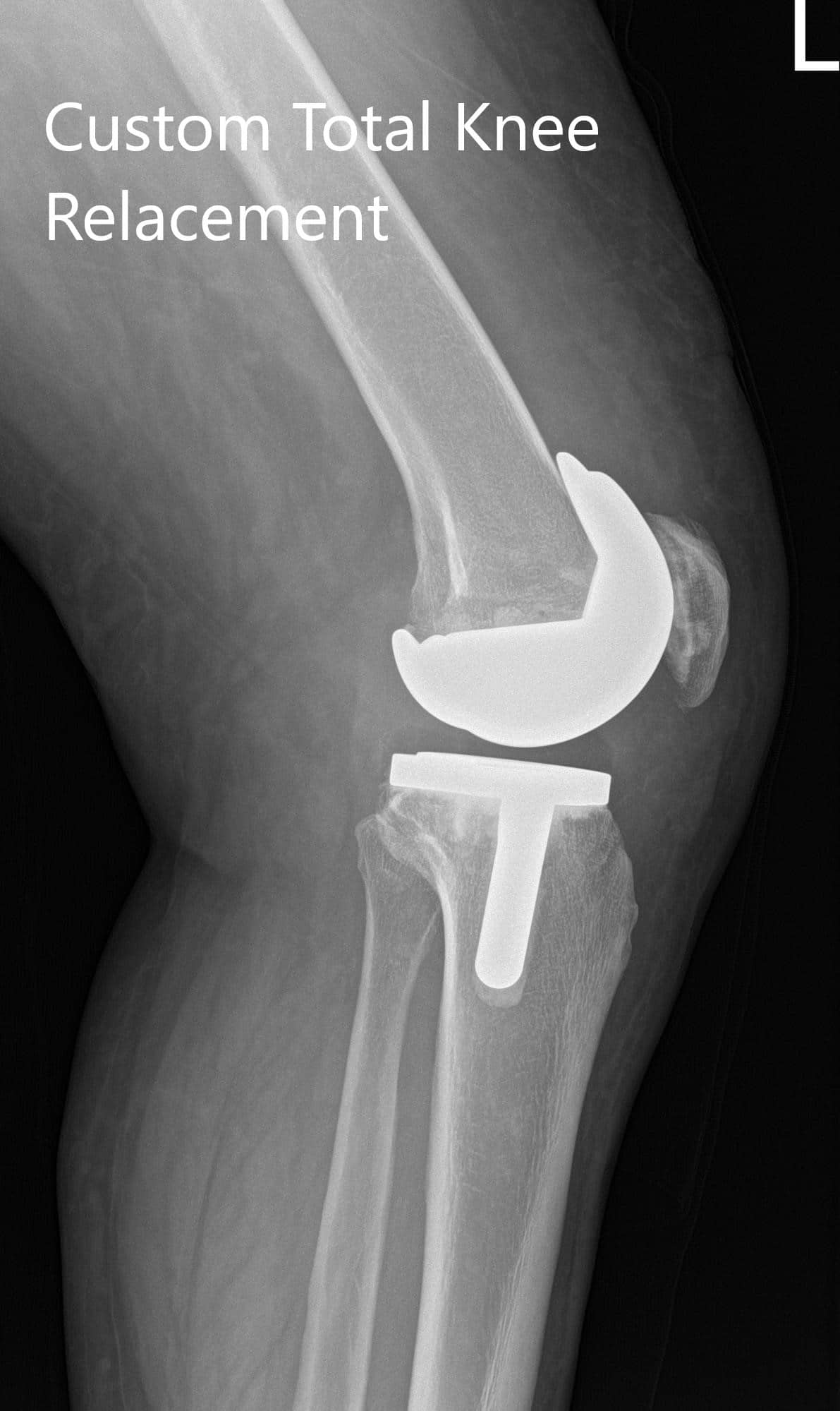 Imágenes de radiografía postoperatorias que muestran la visión AP y lateral de la rodilla izquierda - IMG 2