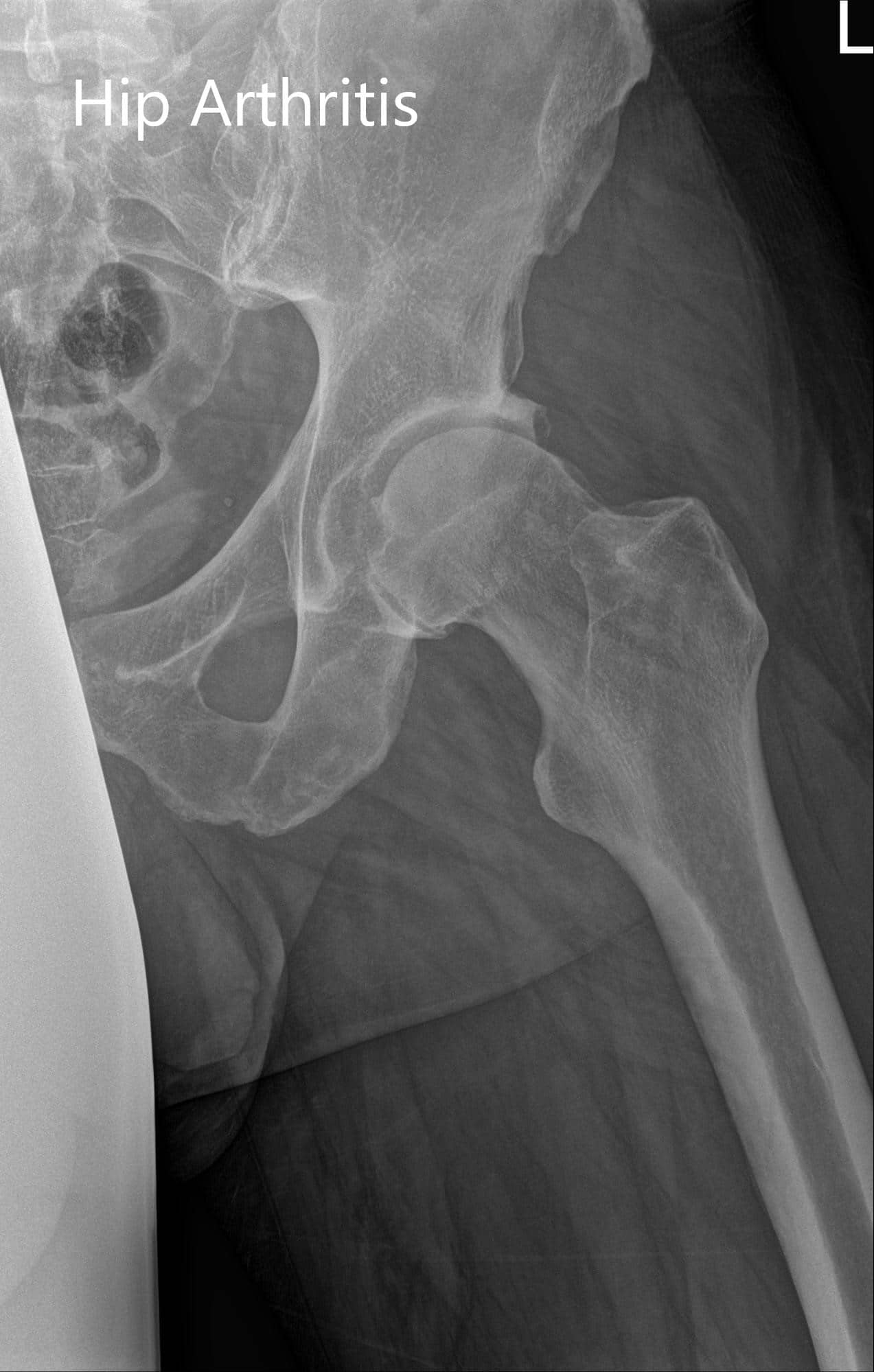 Radiografía preoperatoria de la pelvis con vista AP y vista lateral de la cadera izquierda - img 2