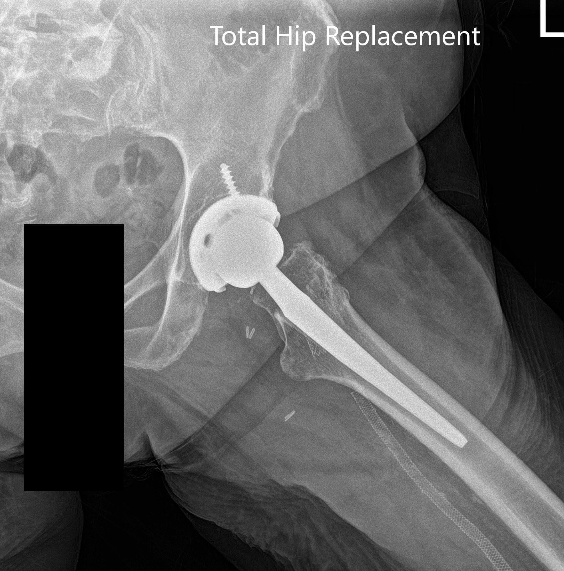 Postoperative X-ray images showing AP and lateral images - img 2