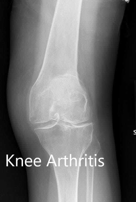 Preoperative X-ray showing the AP view of the left and the right knee respectively Preoperative X-ray showing the AP view of the left and the right knee respectively