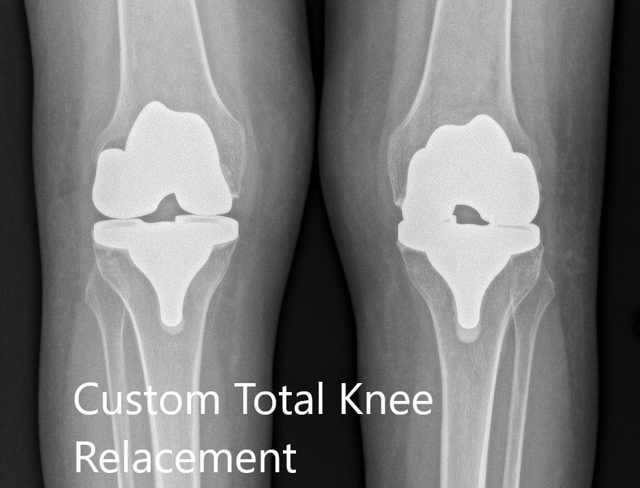 Postoperative X-ray showing the AP view of both knees Postoperative X-ray showing the AP view of both knees