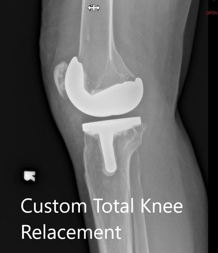 Postoperative X-ray showing the lateral view of the right and the left knee respectively Postoperative X-ray showing the lateral view of the right and the left knee respectively