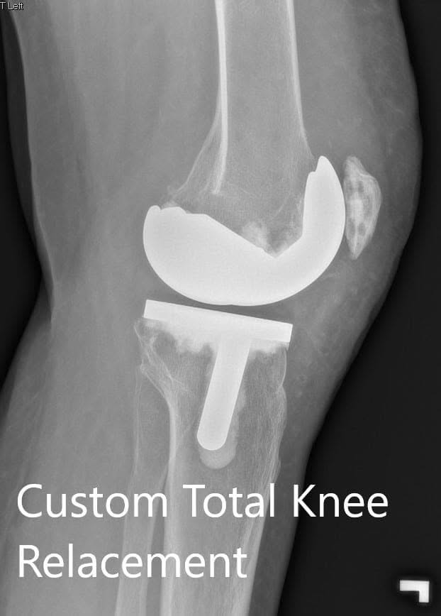 Postoperative X-ray showing the lateral view of the right and the left knee respectively - img 2 Postoperative X-ray showing the lateral view of the right and the left knee respectively - img 2