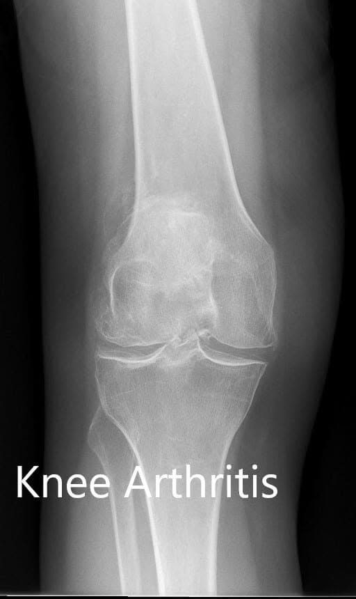 Preoperative X-ray showing the AP view of the left and the right knee respectively - img 2 Preoperative X-ray showing the AP view of the left and the right knee respectively - img 2