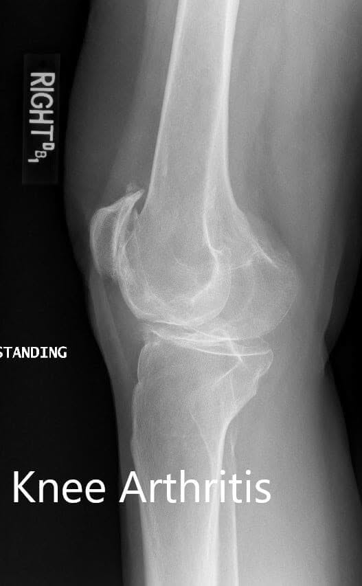 Preoperative X-ray showing the lateral views of the right and the left knee respectively Preoperative X-ray showing the lateral views of the right and the left knee respectively