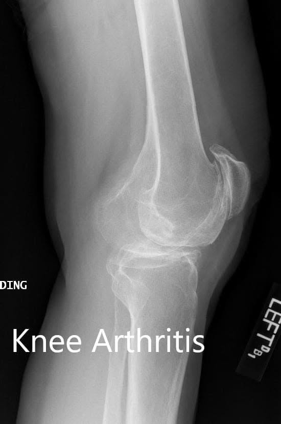 Preoperative X-ray showing the lateral views of the right and the left knee respectively - img 2 Preoperative X-ray showing the lateral views of the right and the left knee respectively - img 2