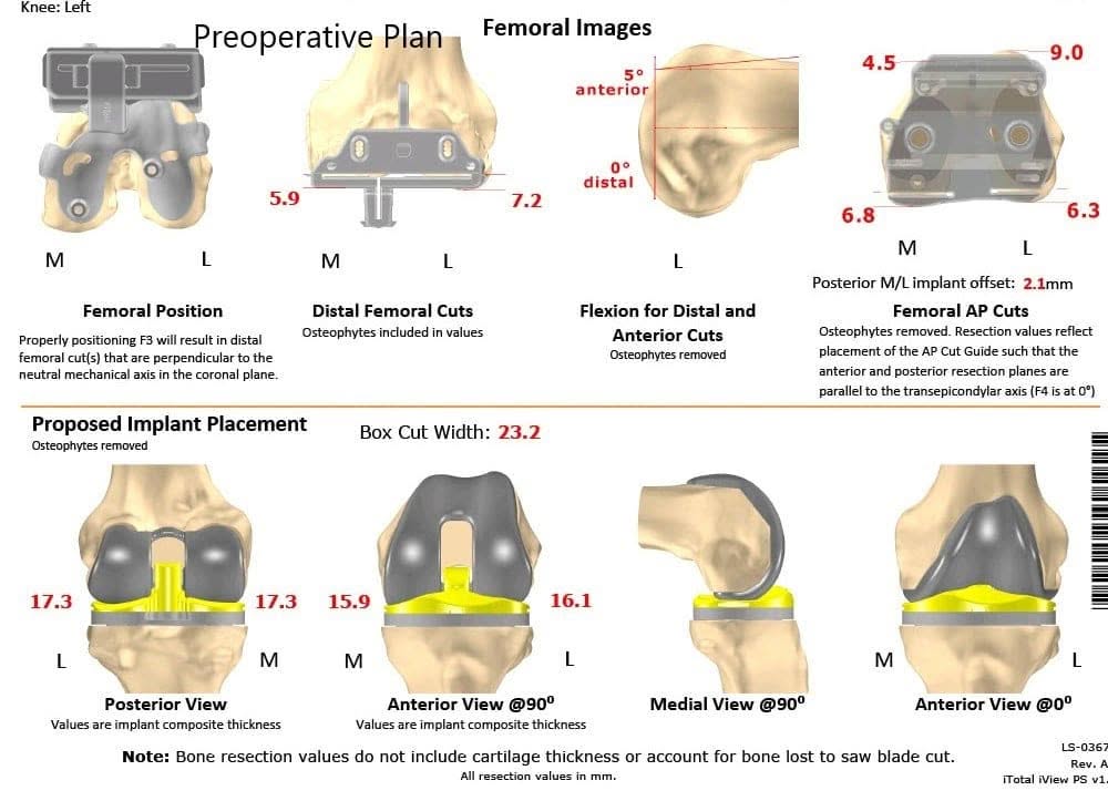 Complete Orthopedics patient specific surgical plan for a Bilateral Customized Total Knee Replacement in a 72-year-old female - scan 2