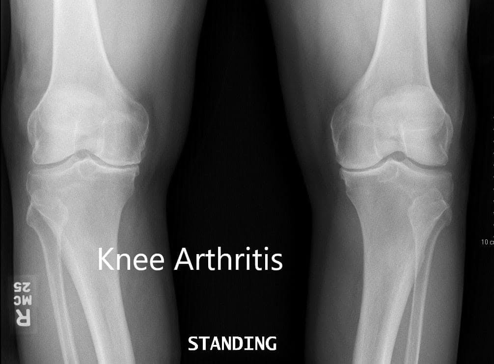 Preoperative X-ray showing the AP view of both knees Preoperative X-ray showing the AP view of both knees