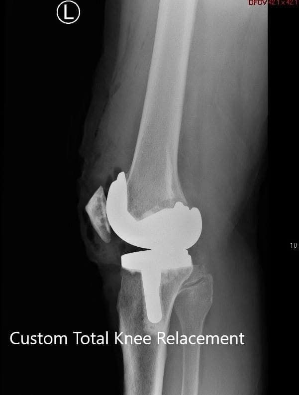 Postoperative X-ray showing the lateral views of both knees - img 2 Postoperative X-ray showing the lateral views of both knees - img 2