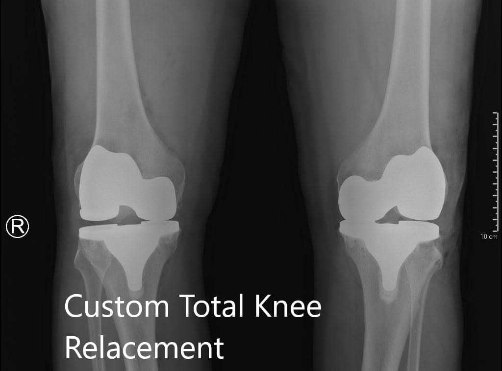 Postoperative X-ray showing the AP view of both knees Postoperative X-ray showing the AP view of both knees