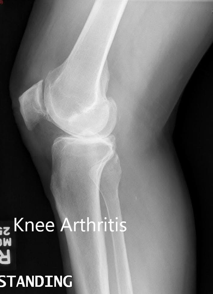 Preoperative X-ray showing the lateral views of the right and the left knee respectively Preoperative X-ray showing the lateral views of the right and the left knee respectively