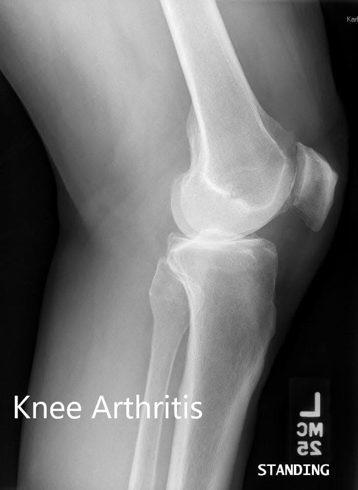 Preoperative X-ray showing the lateral views of the right and the left knee respectively - img 2 Preoperative X-ray showing the lateral views of the right and the left knee respectively - img 2