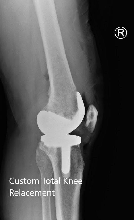 Postoperative X-ray showing the lateral views of both knees Postoperative X-ray showing the lateral views of both knees