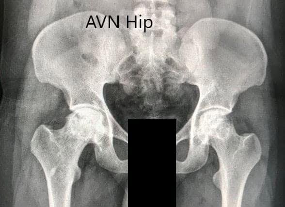 Radiografía preoperatoria de la pelvis con ambas caderas en vista anteroposterior que muestra el AVN de ambas caderas