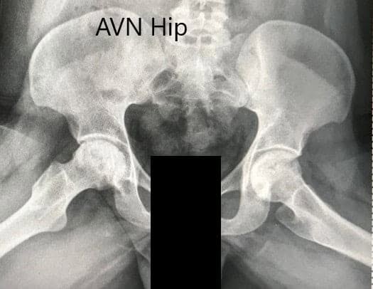 Radiografía preoperatoria de la pelvis con ambas caderas en la vista lateral con patas de rana mostrando la NVA de ambas caderas