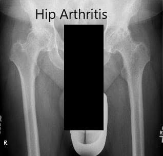 Preoperative X-ray showing the AP view of the pelvis with both the hips