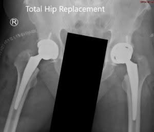 Postoperative X-ray showing the AP view of the pelvis with both hips