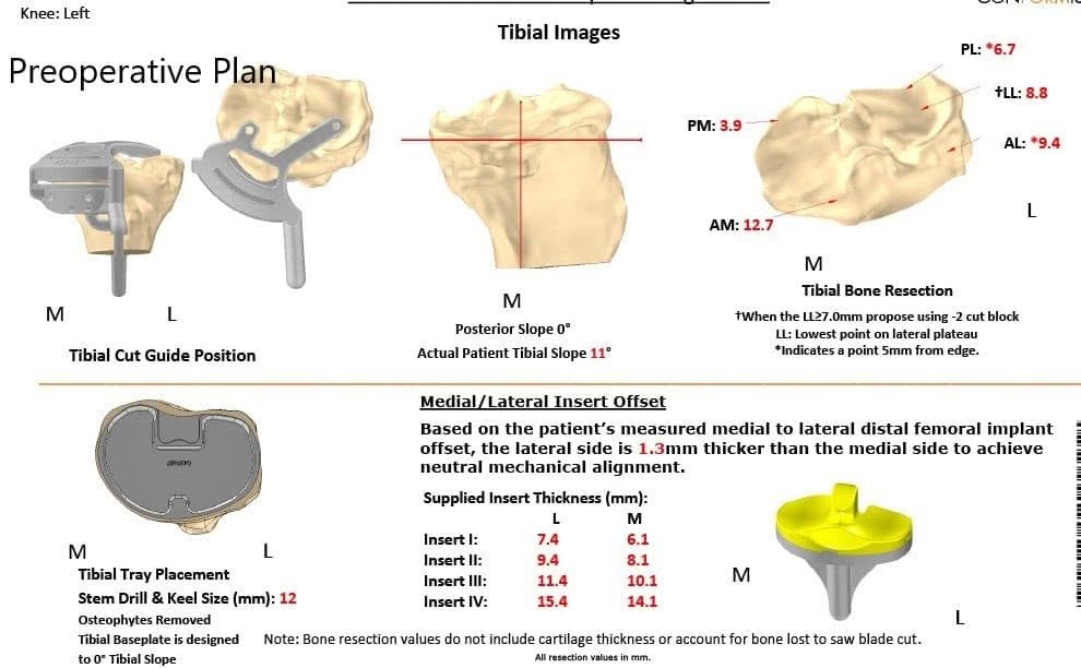 Plan quirúrgico completo específico para pacientes en ortopedia para un reemplazo personalizado de rodilla izquierda en un hombre de 71 años