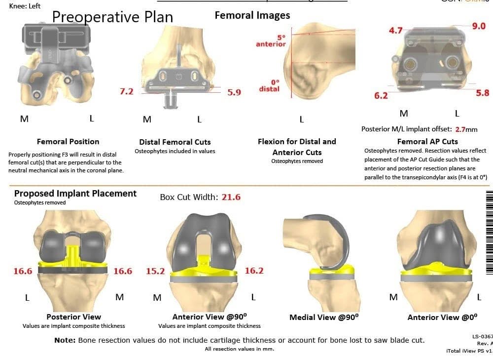 Plan quirúrgico completo específico para pacientes en Ortopedia para un reemplazo personalizado de rodilla izquierda en un hombre de 71 años - escaneo 2