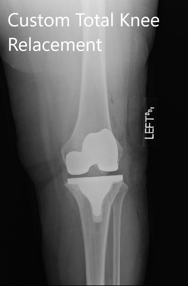 Imágenes de radiografías postoperatorias que muestran la AP y las vistas laterales de la rodilla izquierda