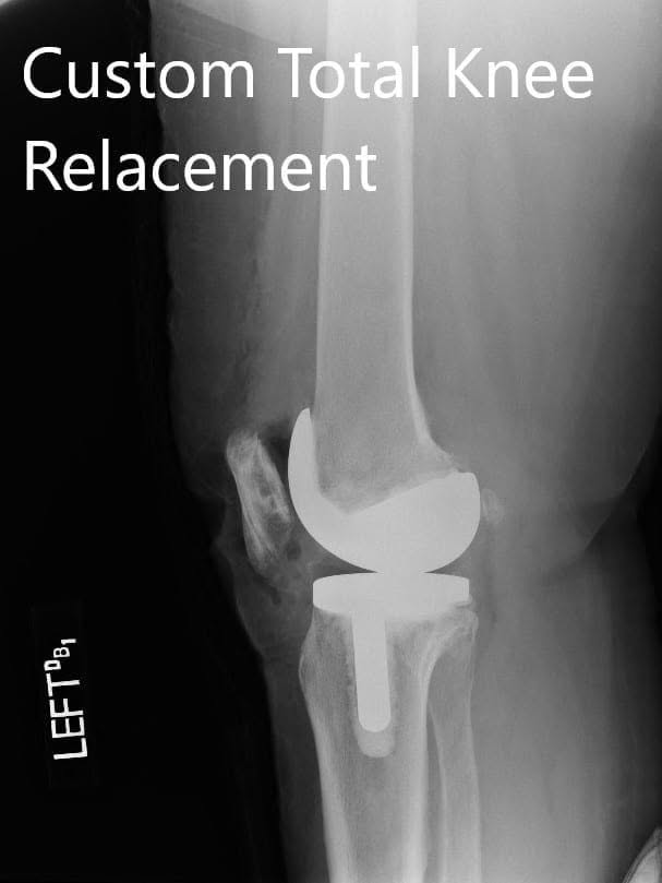 Imágenes postoperatorias de radiografías que muestran la AP y las vistas laterales de la rodilla izquierda - IMG 2