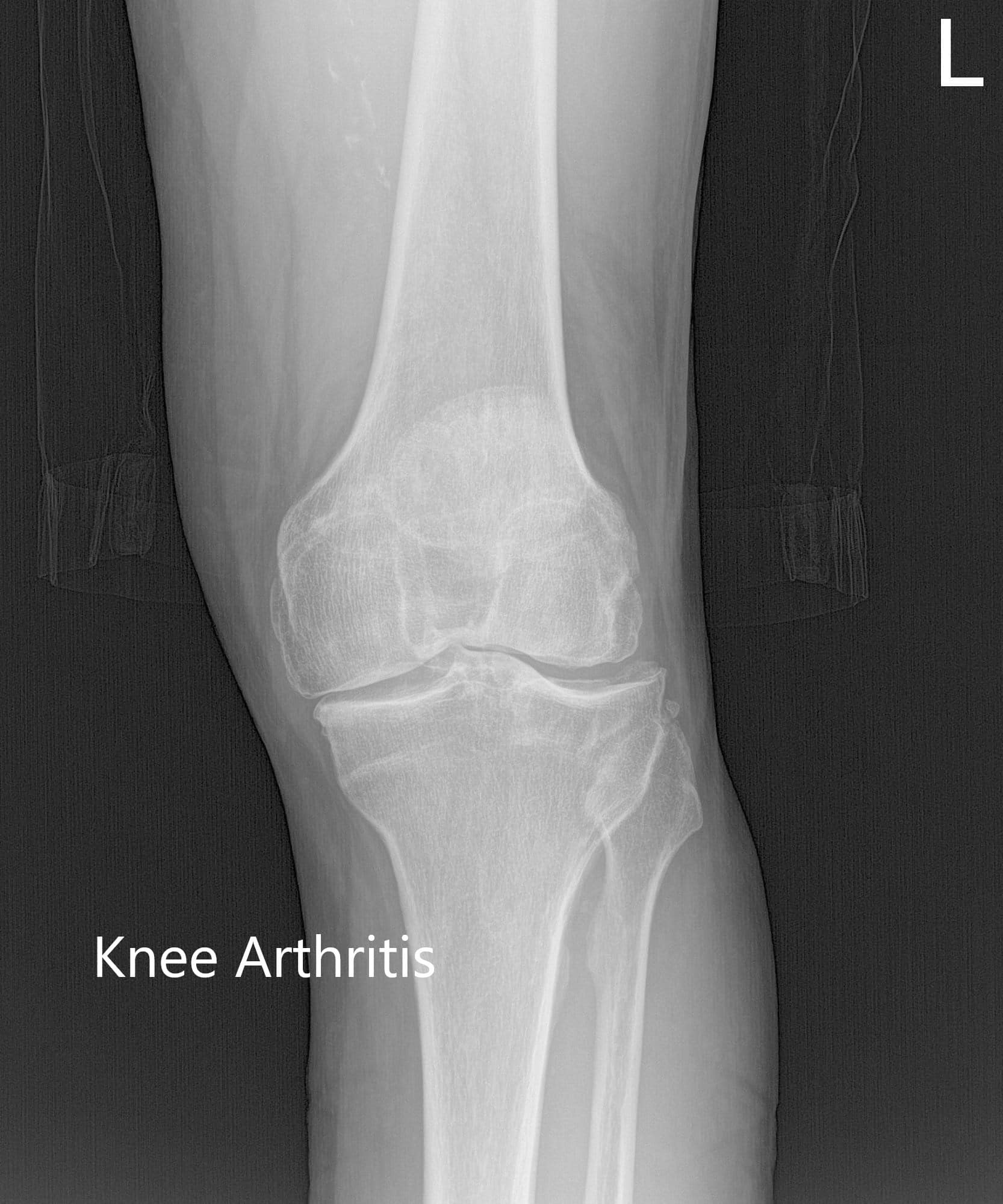 Preoperative X-ray of the left knee showing AP, lateral and merchant views Preoperative X-ray of the left knee showing AP, lateral and merchant views