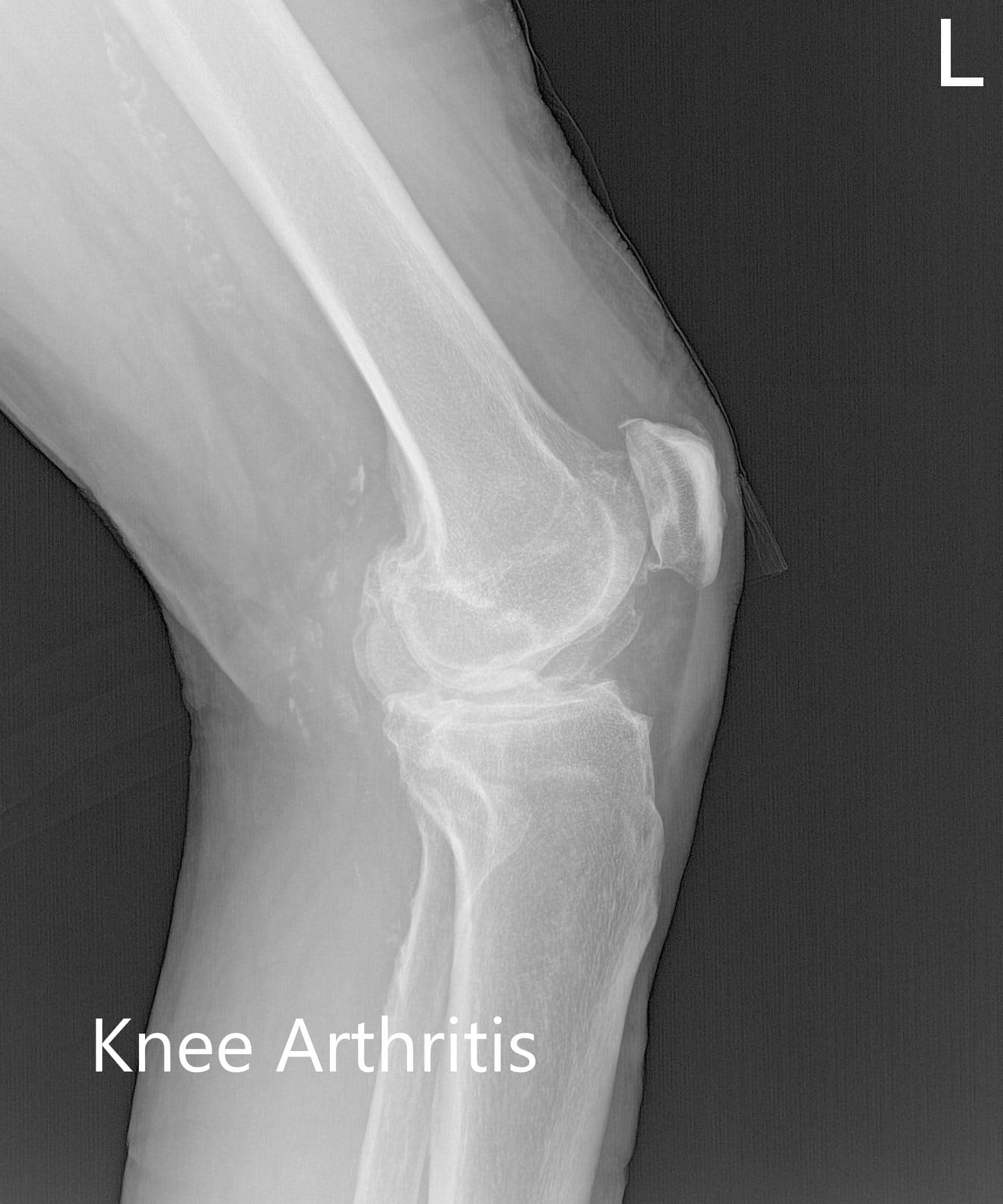 Preoperative X-ray of the left knee showing AP, lateral and merchant views - img 2 Preoperative X-ray of the left knee showing AP, lateral and merchant views - img 2