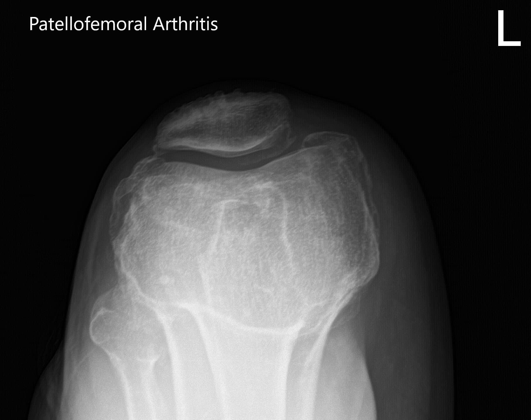 Preoperative X-ray of the left knee showing AP, lateral and merchant views - img 3 Preoperative X-ray of the left knee showing AP, lateral and merchant views - img 3