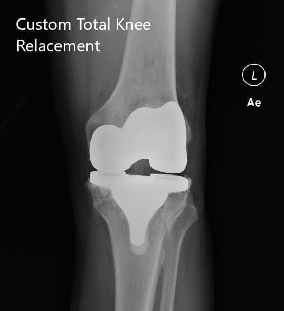 Postoperative X-ray of the left knee showing AP and lateral views Postoperative X-ray of the left knee showing AP and lateral views