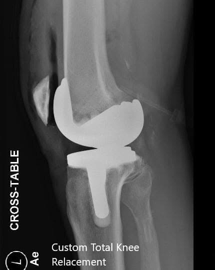 Postoperative X-ray of the left knee showing AP and lateral views - img 2 Postoperative X-ray of the left knee showing AP and lateral views - img 2