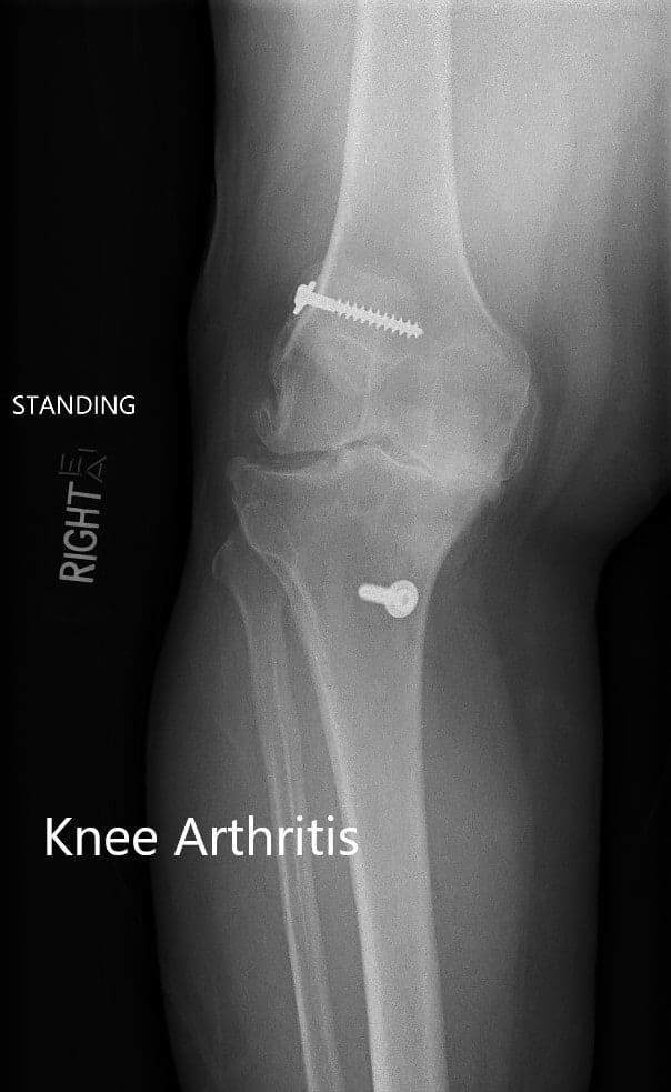 Preoperative X-ray showing the AP and lateral views of the right knee with retained screws consistent with ACL reconstruction Preoperative X-ray showing the AP and lateral views of the right knee with retained screws consistent with ACL reconstruction