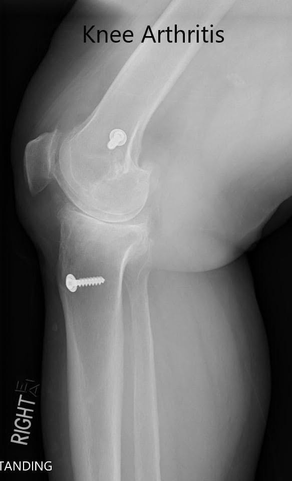 Preoperative X-ray showing the AP and lateral views of the right knee with retained screws consistent with ACL reconstruction - img 2 Preoperative X-ray showing the AP and lateral views of the right knee with retained screws consistent with ACL reconstruction - img 2